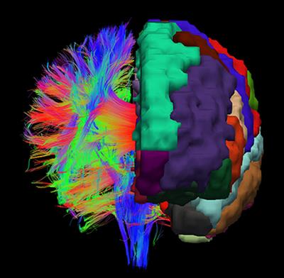 Cortex Parcellation Associated Whole White Matter Parcellation in Individual Subjects